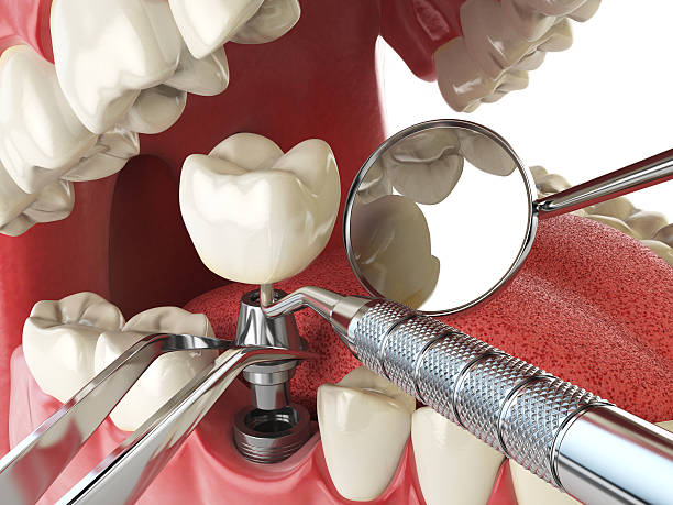 Best Emergency Cosmetic Dentistry (e.g., broken veneers) in Schriever, LA